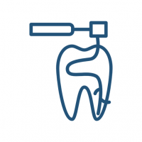 Kiek užtrunka dantų šaknų kanalų gydymas?